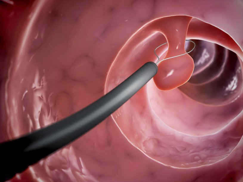Polyp đại tràng khi nào cần cắt bỏ? | Khoa học và Đời sống